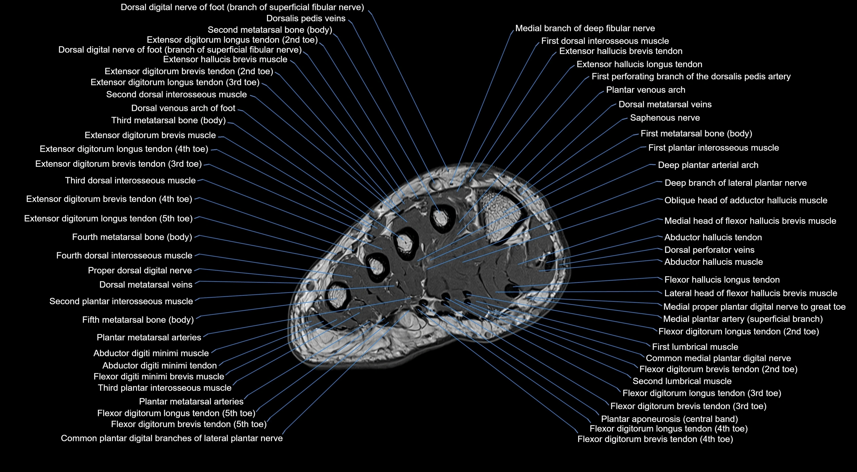 MRI mid foot coronal ligaments cross sectional anatomy 3T  radiology  image-img-00001-00004.webp
